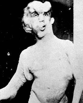 John Merrick, the 'elephant man'