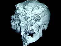 John Merrick's skull